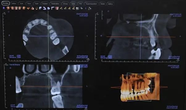 X- ray | SL Endodontics | Dr. Sameer Lakho