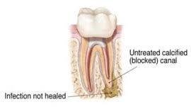 SL Endodontics | Dr. Sameer Lakho
