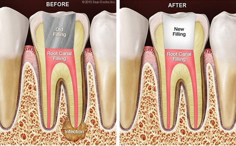 Root Canal Retreatment | SL Endodontics